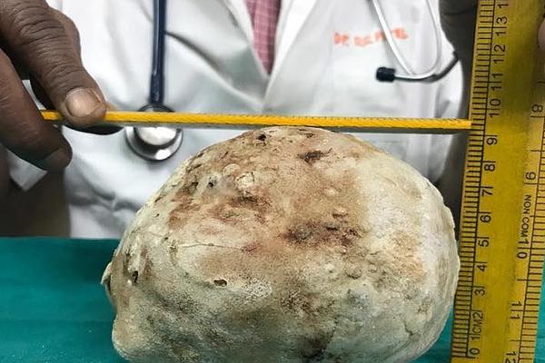 印男子膀胱取出1.5公斤结石