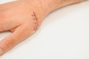cuts and lacerations - types of car accident injuries- car accident attorneys Woodstock, GA- Hagood Injury Law